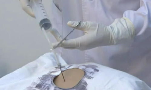 男子肝癌晚期只打一针获新生