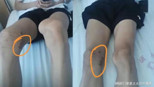 体育生被错切右膝 母亲:不接受和解