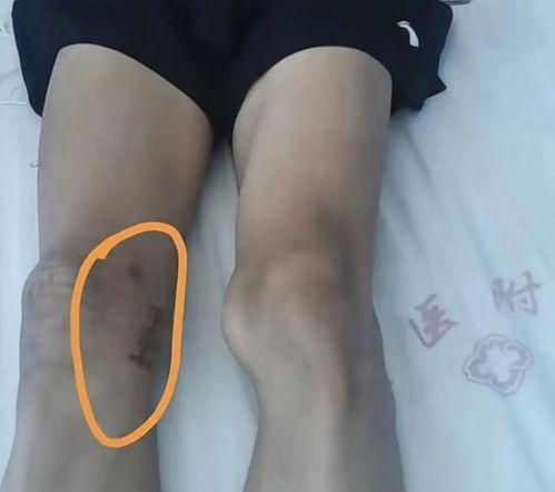 体育生被错切右膝 母亲:不接受和解