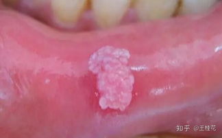 在酒店干了啥才会感染HPV 在酒店干了啥才会感染HPV