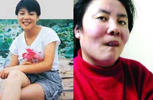 女童突然脱发眼神呆滞 查出铊中毒 女童突然脱发眼神呆滞 查出铊中毒