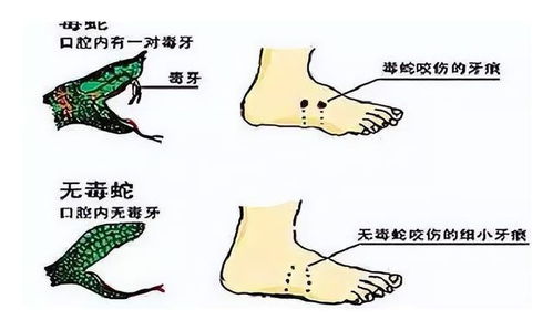 被毒蛇咬 要把蛇弄死带给医生看?遭遇毒蛇咬伤,正确处理与应对的重要性) 被毒蛇咬 要把蛇弄死带给医生看?遭遇毒蛇咬伤,正确处理与应对的重要性)
