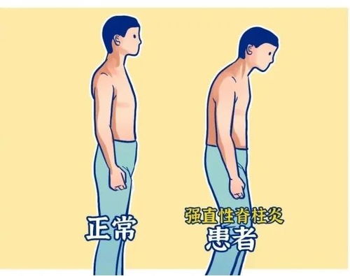周杰伦强直性脊柱炎疑似加重(周杰伦疑似强直性脊柱炎病情加重,音乐巨星的健康挑战) 周杰伦强直性脊柱炎疑似加重(周杰伦疑似强直性脊柱炎病情加重,音乐巨星的健康挑战)
