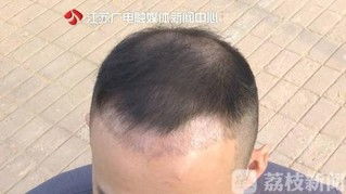 女子因发量太多剃掉五分之四头发(女子因发量太多决定剃掉五分之四的头发，一次关于自我接纳与改变的冒险之旅)