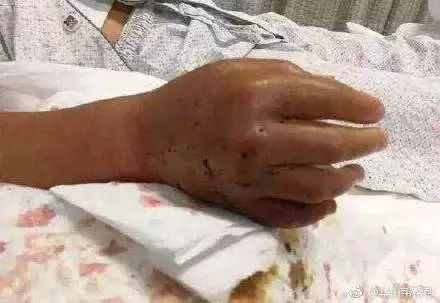 老人被毒蛇咬伤:医生说比骨折还痛(老人被毒蛇咬伤,痛楚超越骨折的严峻警示) 老人被毒蛇咬伤:医生说比骨折还痛(老人被毒蛇咬伤,痛楚超越骨折的严峻警示)