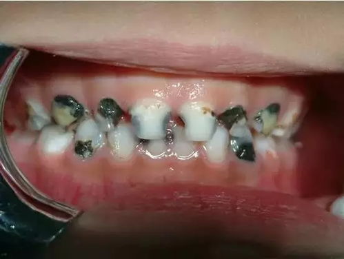 这些腐蚀牙齿的饮料你可能每天都喝(这些腐蚀牙齿的饮料你可能每天都喝)