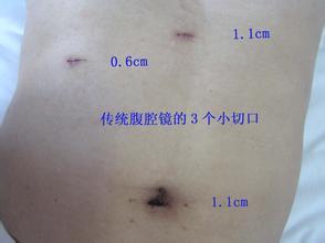 颖儿做了割胆手术(颖儿,割胆手术后的新篇章) 颖儿做了割胆手术(颖儿,割胆手术后的新篇章)